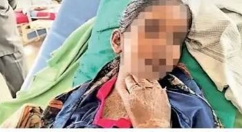 तुळजापूरच्या मुलीला कुष्ठरोगाच्या गोळ्यांची रिऍक्शन